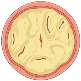 Healthy tissue stage